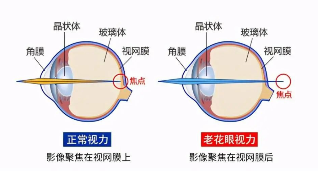 近视叠加老花，就没有省心的解决办法吗？｜康明眼科带你解锁远中近全程清晰方案